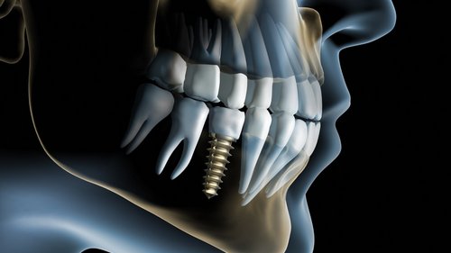 Your dentist in Bogenhausen and Brixen Your dentist in Bogenhausen and Brixen